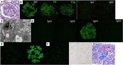 Proliferative glomerulonephritis with monoclonal immunoglobulin G3 lambda deposits accompanied by glomerular positive staining for nephritis-associated plasmin receptor and related plasmin activity: A report of two cases